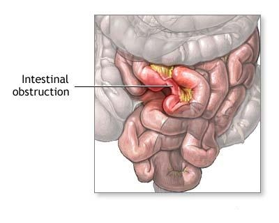 Ocluzie intestinala acuta (ileus)